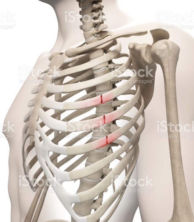 Broken Ribs Stock Photo 470573549 Istock - Parents Accused